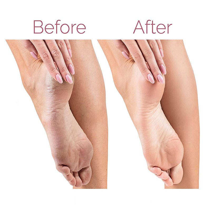 electric pedicure foot care
